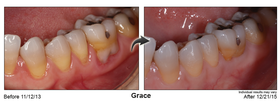 fix gum recession Orange County