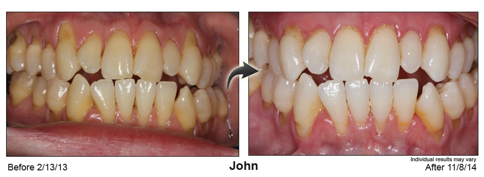 Orange County gum recession