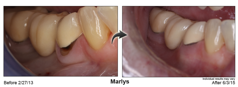 fix receding gums Orange County