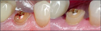 functional crown lengthening