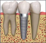 dental implant