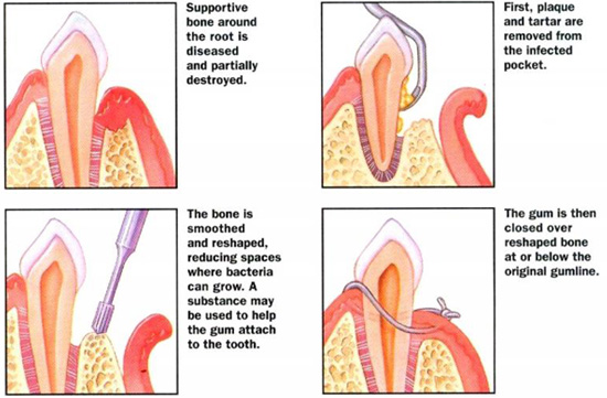 periodontal treatment