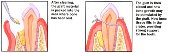 surgical perio treatment