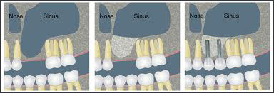 sinus lift procedure