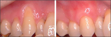 soft tissue grafts